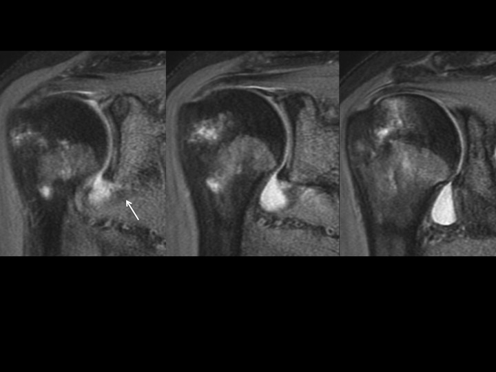 Figure 2 for case Glenoid Avulsion Glenohumeral Ligament